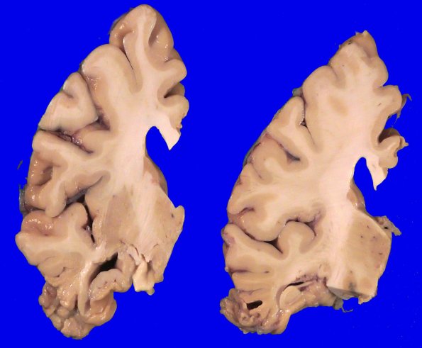 5A4 Pick Dz (Case 5) _4