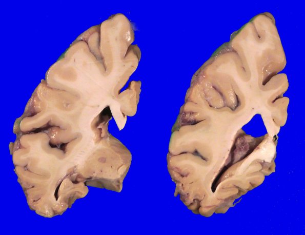 5A5 Pick Dz (Case 5) _5