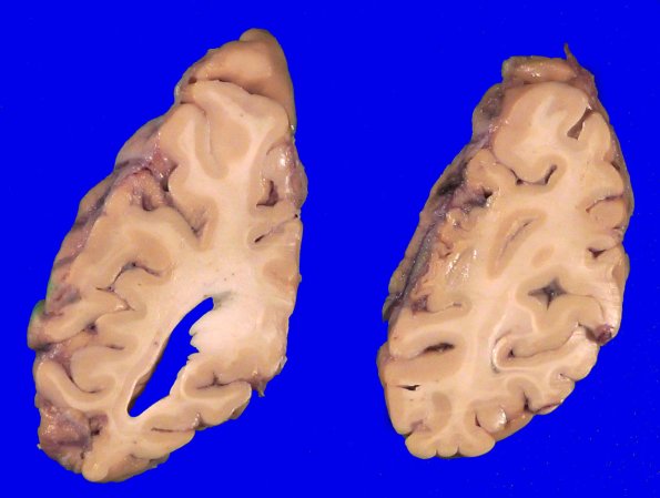 5A6 Pick Dz (Case 5) _6