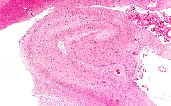 5B1 Picks Dz (Case 5) L5 H&E 2X