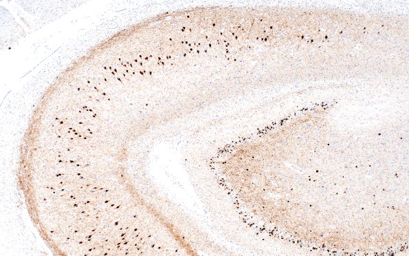 5C2 Picks Dz (Case 5) L5 10X