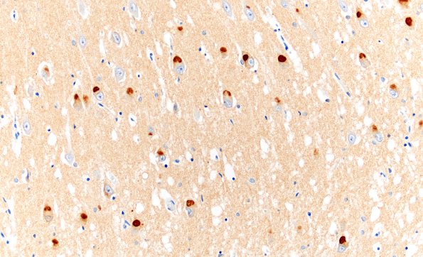 5D7 Picks Dz (Case 5) L5 3R Tau 20X CA1