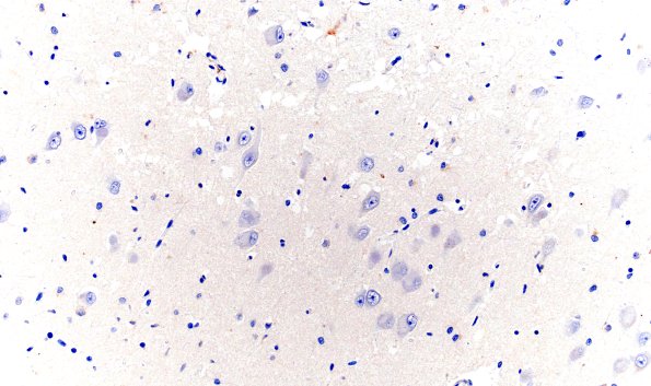 5D8 Picks Dz (Case 5) L5 4R Tau 20X CA1