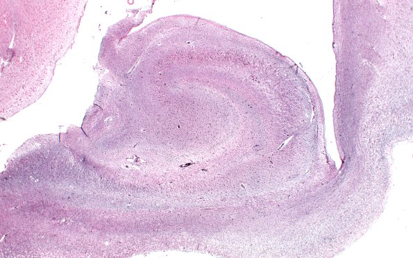 6D1 Pick Dz (Case 6) HC Bodian 2X