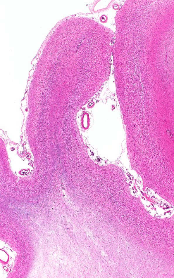 7B2 Pick Dz (Case 7) HC H&E 2X