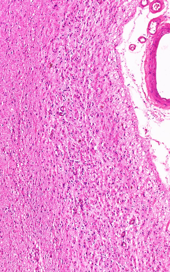 7B3 Pick Dz (Case 7) HC H&E 10X