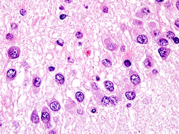 7B9 Pick Dz (Case 7) L55 H&E 10