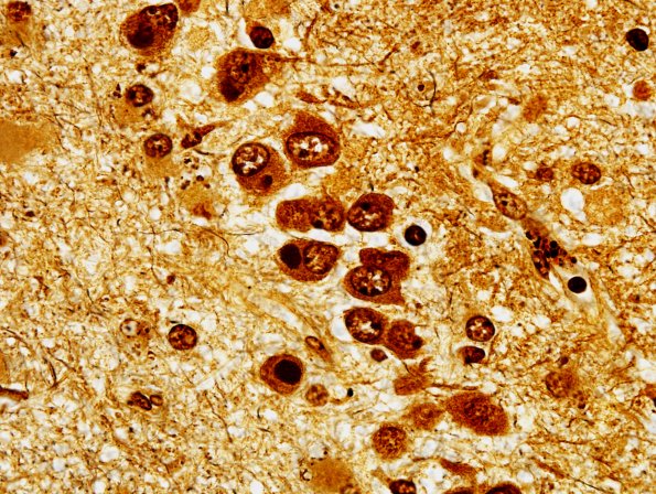 7C2 Pick Dz (Case 7) L55 Biels 100X 1