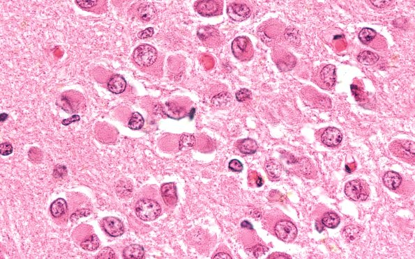 8B2 Pick Dz (Case 8) HC 100X 2