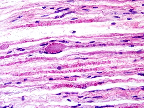 10B Polyglucosan body (Case 10B) roots H&E 1.jpg