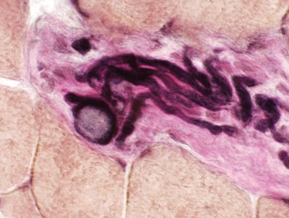 10D1 Polyglucosan body (Case 10D) VVG 1.jpg