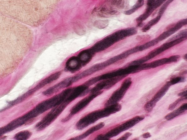 10D2 Polyglucosan body (Case 10D) VVG 2.jpg