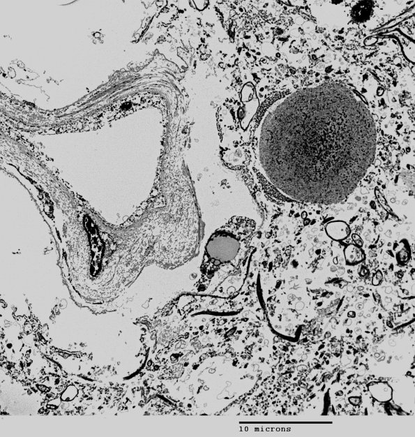 10G1 Polyglucosan Body (Case 10G) EM 015 - Copy