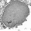 10H1 AD (Case 10H) Polyglucosan body EM 128 - Copy