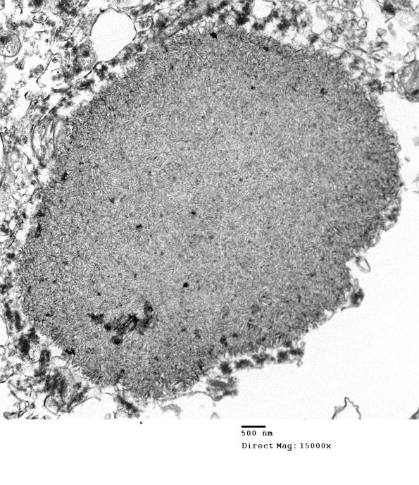 10H1 AD (Case 10H) Polyglucosan body EM 128 - Copy