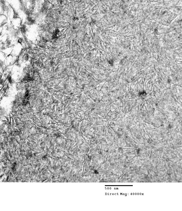 10H2 AD (Case 10H) Polyglucosan body EM 129 - Copy