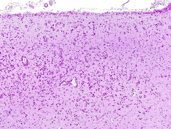 2B3 (CANP 2007 Case 9) PAS 3