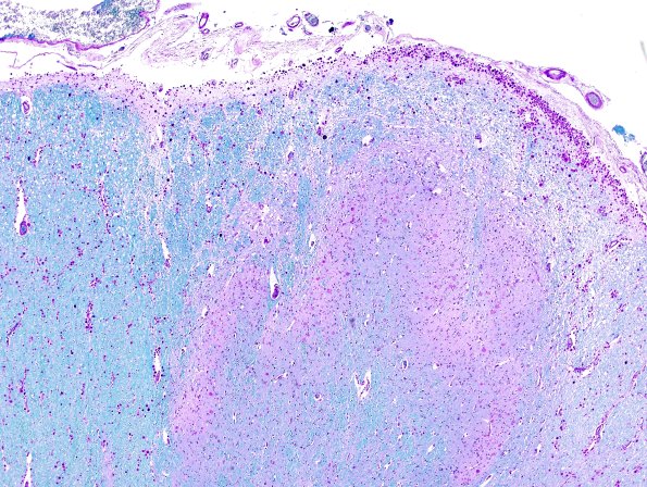 3B1 PGB (Case 3) DHorn LFB-PAS 7