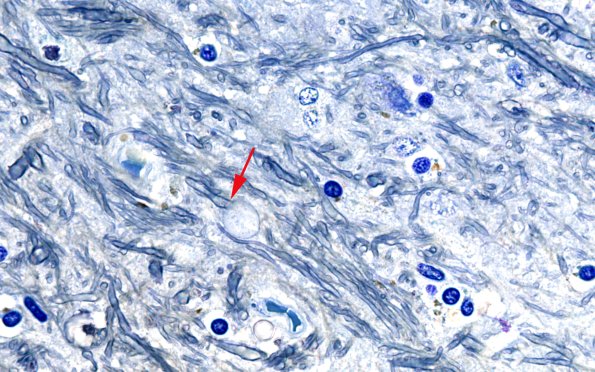 3D8 PGB (Case 3) DHorn Plastic 9 100X copy