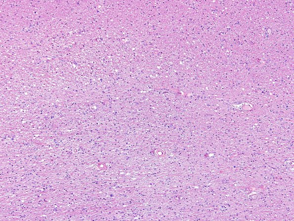 5B4 Hemorrhage APBDz (Case 5) H&E 5