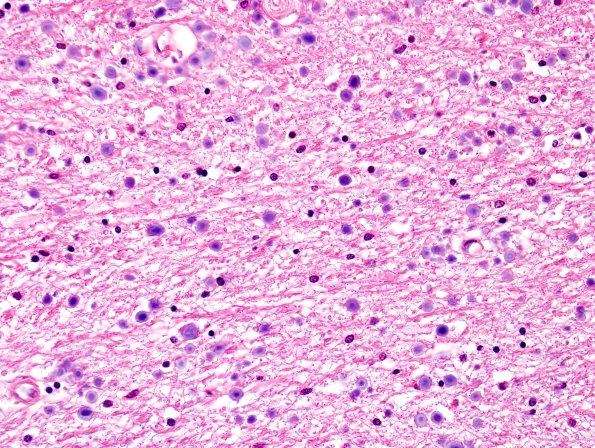 5B5 Hemorrhage APBDz (Case 5) H&E 1