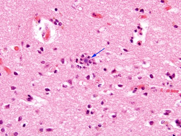 5B6 Hemorrhage APBDz (Case 5) H&E 3 copy