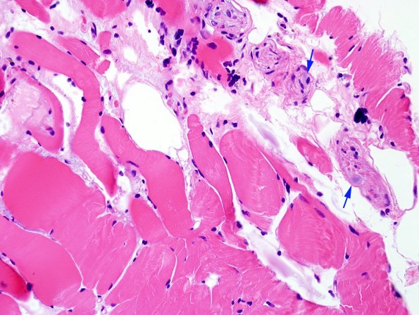 7A1 PGB muscle nerve (Case 7) H&E 1 copy.jpg