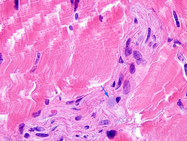 7A2 PGB muscle nerve (Case 7) H&E 4 copy.jpg