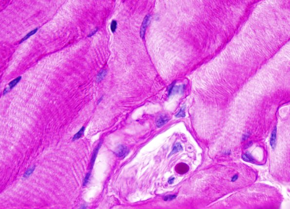 7B3 PGB Intramuscle (Case 7) PAS 4.jpg