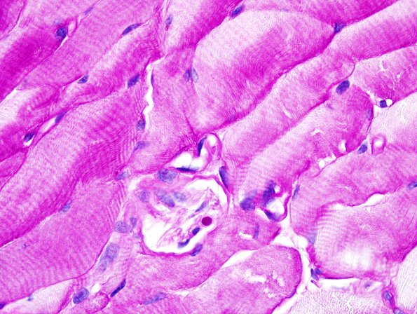 7B4 PGB intramuscle (Case 7) PAS 6.jpg