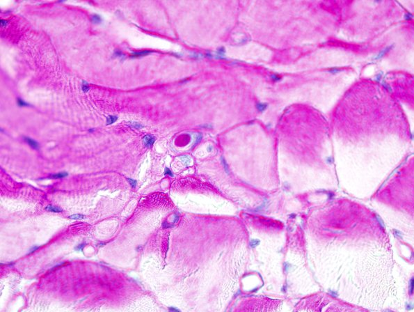 7B5 PGB intramuscle (Case 7) PAS 2.jpg