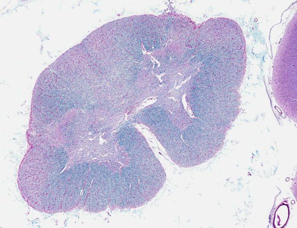 9A1 Polyglucosan Body Dz (AANP 1995, Case 5) LFB-PAS X1.5 1