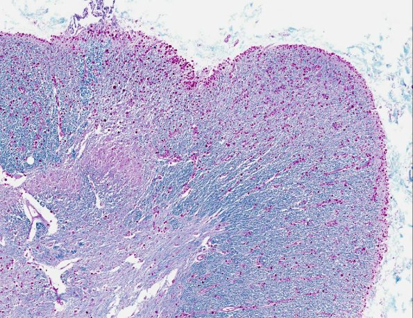 9A2 Polyglucosan Body Dz (AANP 1995, Case 5) LFB-PAS X4 3