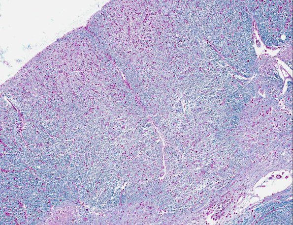 9A3 Polyglucosan Body Dz (AANP 1995, Case 5) LFB-PAS X4 2