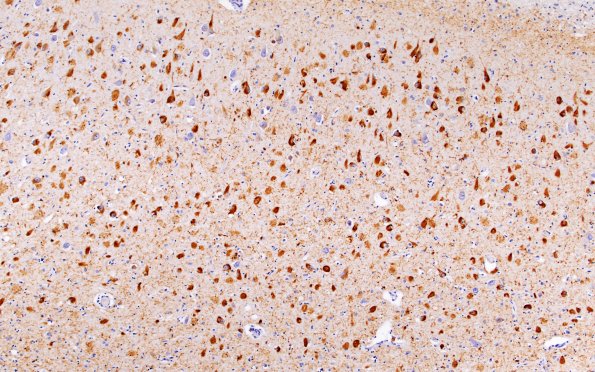 1B4 PART, AGD, DLBD, No AD (Case 1) PHF 10X