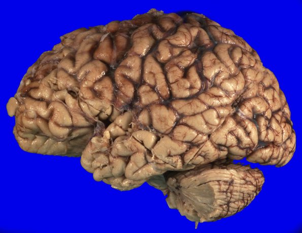 2A1 Primary Age-Related Tauopathy (PART, Case 2) H&E 2_1