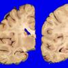 2A2 Primary Age-Related Tauopathy (PART, Case 2) H&E 2_2