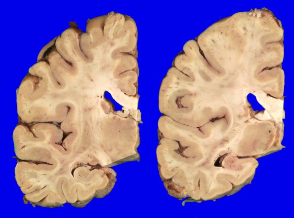 2A2 Primary Age-Related Tauopathy (PART, Case 2) H&E 2_2