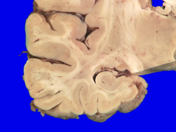 2A3 Primary Age-Related Tauopathy (PART, Case 2) H&E 2_3