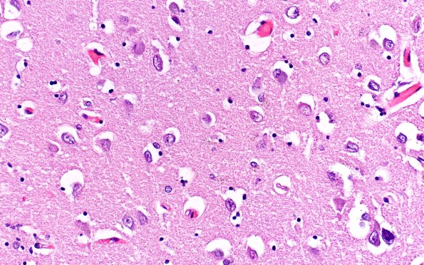 2B2 PART (Case 2) H&E 40X