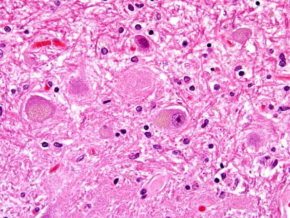 10B2 PSP & DLBD (Case 10) Grumose Degeneration H&E.jpg