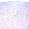 10C1 PSP & DLBD (Case 10) tufted Astrocyte PHF1 16.jpg