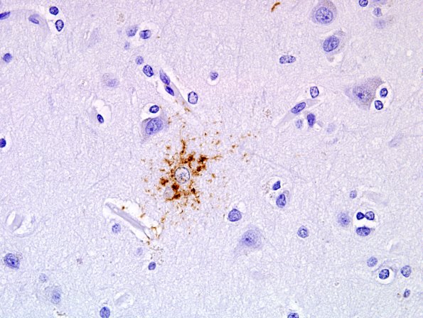 10C2 PSP & DLBD (Case 10) tufted Astrocyte PHF1 2.jpg