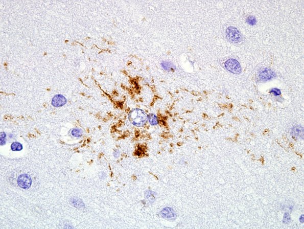 10C3 PSP & DLBD (Case 10) tufted Astrocyte PHF1 5.jpg