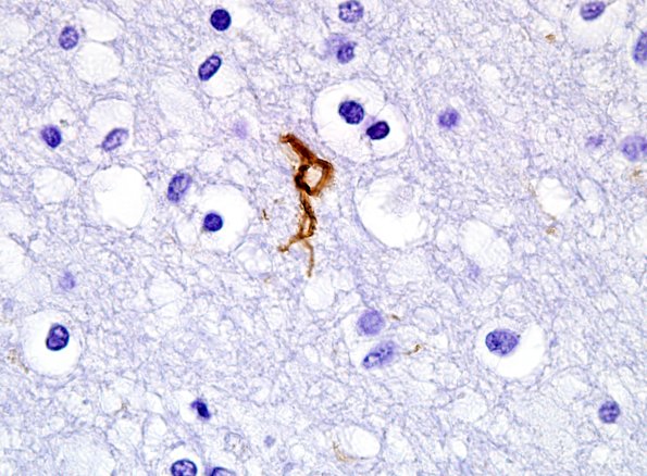 10C4 PSP & DLBD (Case 10) coiled body PHF1.jpg