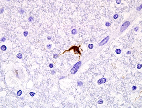 10C5 PSP & DLBD (Case 10) coiled body PHF1 2.jpg