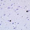 10D3 PSP & DLBD (Case 10) pSYN 1 14.jpg