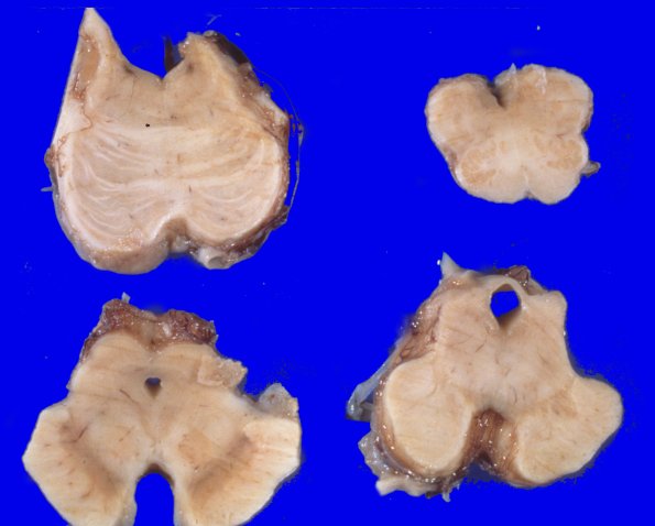 11A3 PSP  cortical NFT (Case 11) gross 1