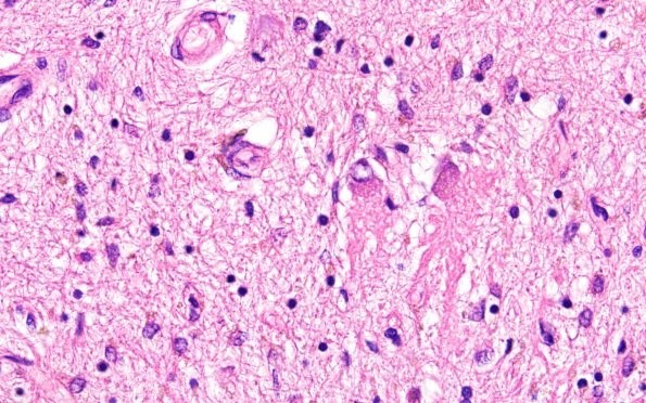 12B3 PSP (Case 12) N10 dentate (grumose degeneration) H&E 5