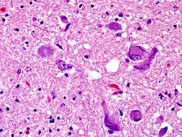 13B2 PSP (Case 13) N6 IIIrd nerve H&E 1.jpg